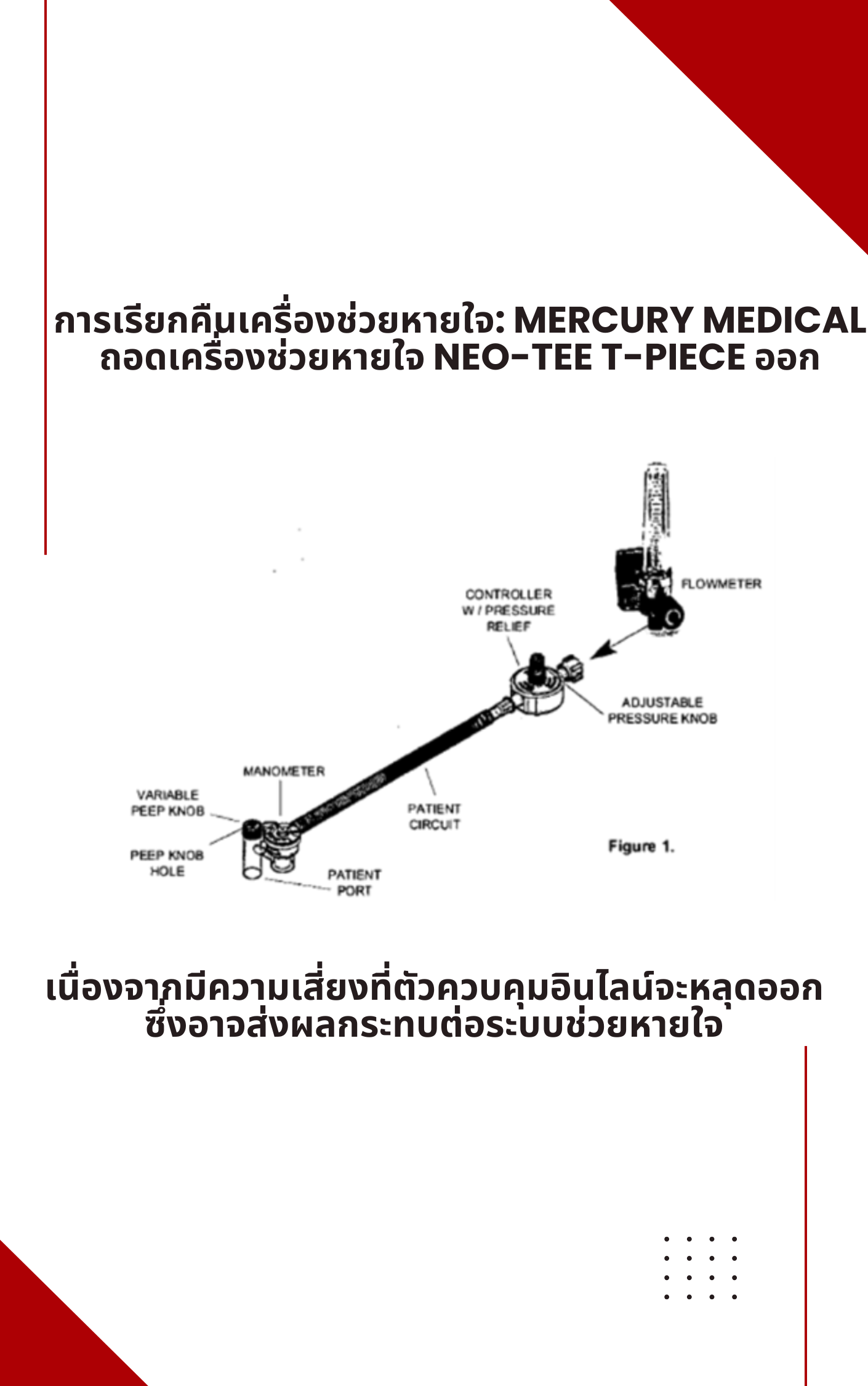 การเรียกคืนเครื่องช่วยหายใจ: Mercury Medical ถอดเครื่องช่วยหายใจ Neo-Tee T-Piece ออกเนื่องจากมีความเสี่ยงที่ตัวควบคุมอินไลน์จะหลุดออกซึ่งอาจส่งผลกระทบต่อระบบช่วยหายใจ